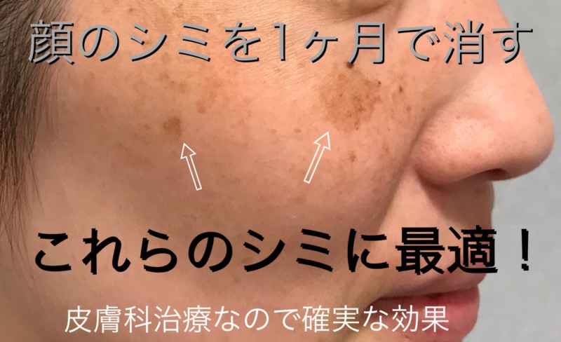 顔のシミを1か月で消す方法 治療手引き 皮膚科専門医dr Miko