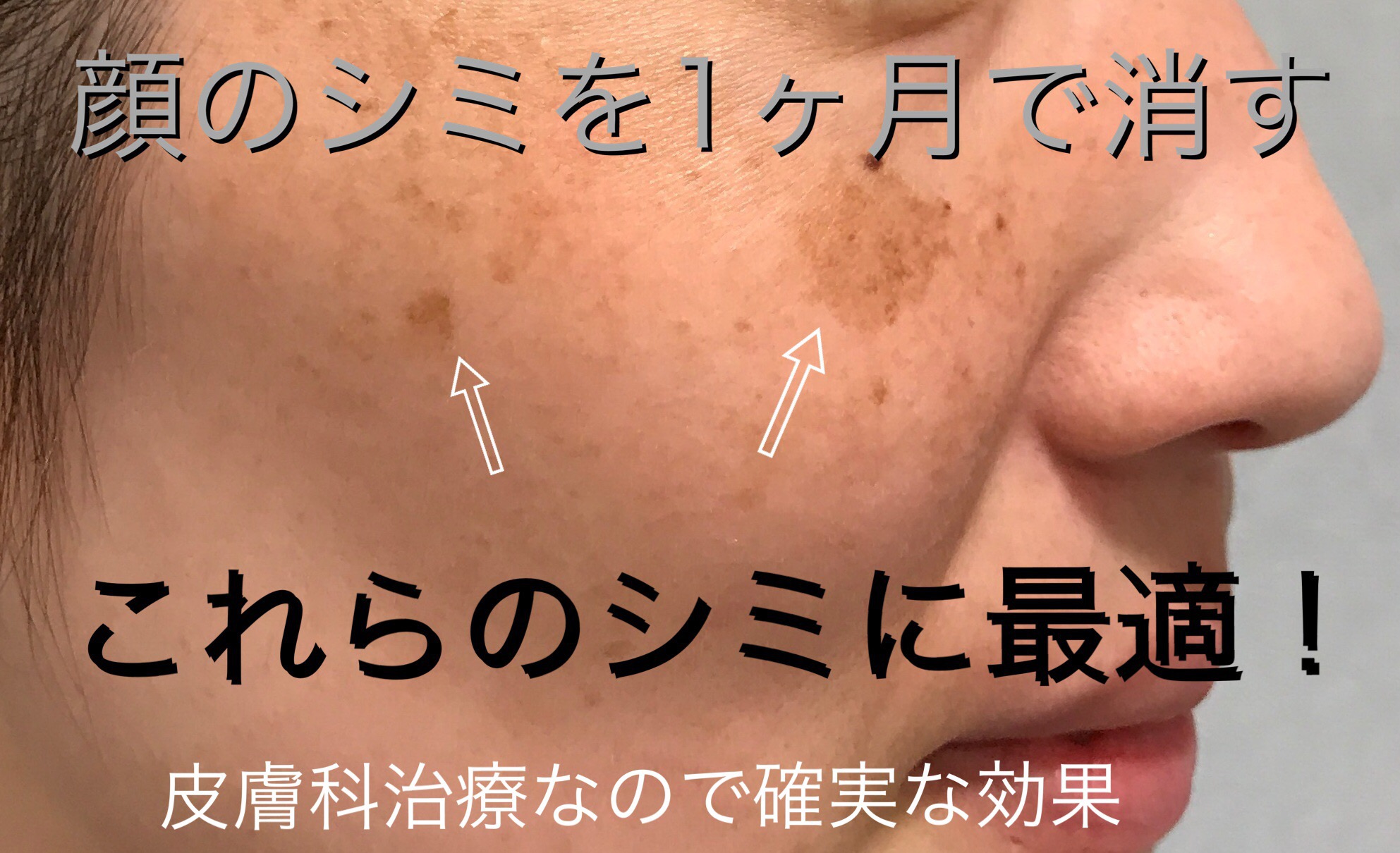 顔 の シミ を 消す 皮膚 科