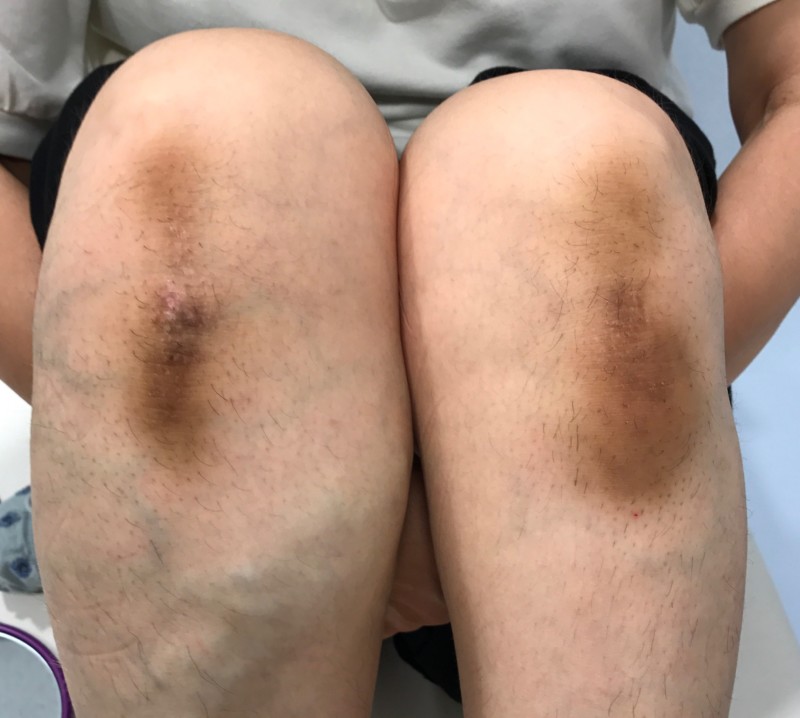 膝やくるぶしの黒ずみを取る 皮膚科専門医dr Miko
