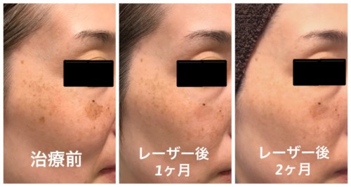 シミのレーザー治療2ヵ月後 皮膚科専門医dr Miko