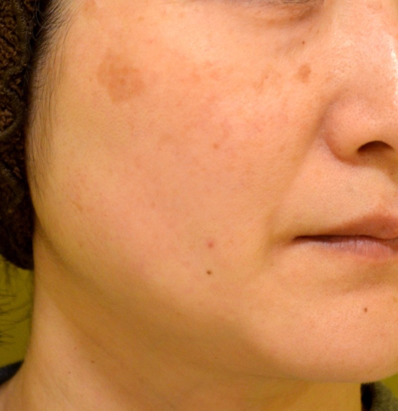 皮膚科の美容相談室 レーザー照射後の炎症後色素沈着 どうしたらいいですか 皮膚科専門医dr Miko