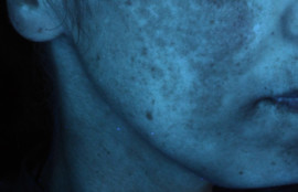 膝やくるぶしの黒ずみを取る 皮膚科専門医dr Miko