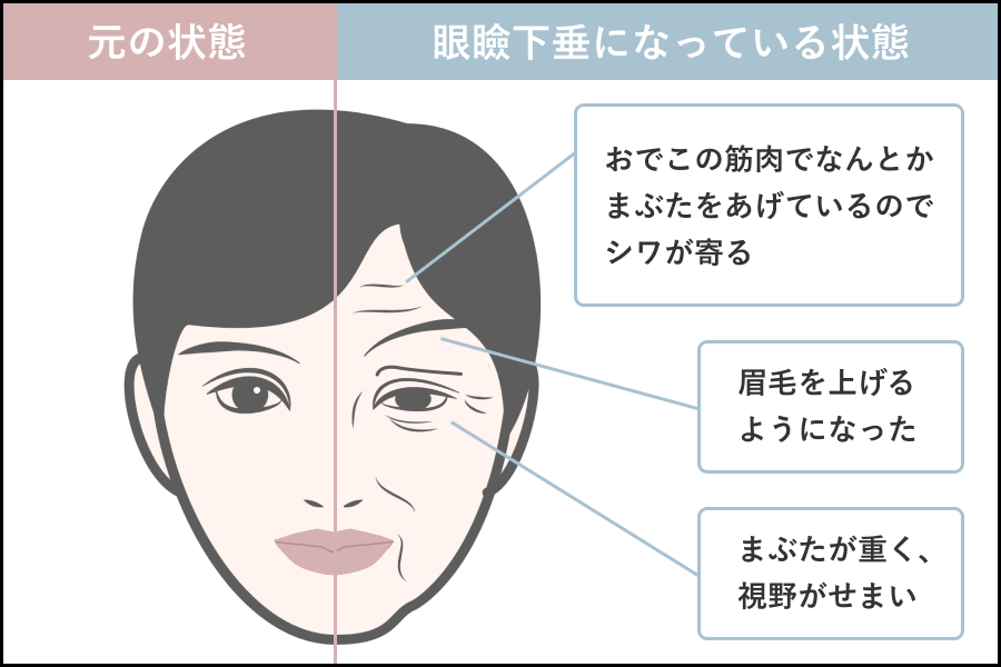 おでこのシワ、眼瞼下垂